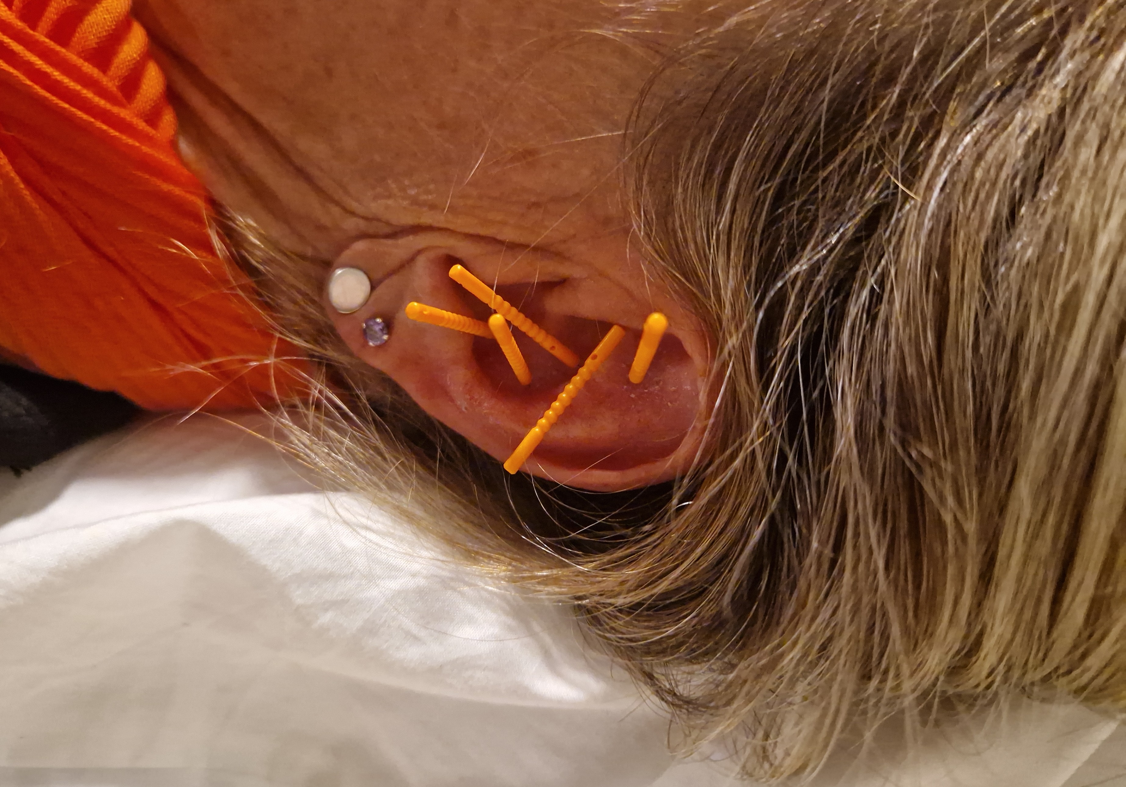 Ear Acupuncture Course